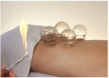 Cupping is part of Traditional Chinese Medicine (TCM)